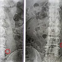尿管結石のレントゲン写真